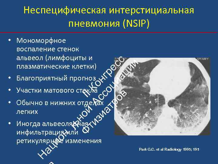 Неспецифическая интерстициальная пневмония (NSIP) ьн Ф ой II ти А К зи с он