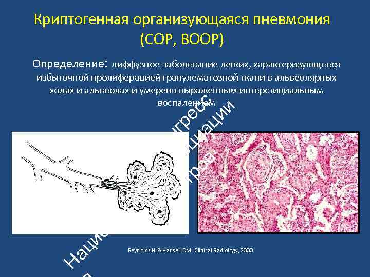 Криптогенная организующаяся пневмония (COP, BOOP) Определение: диффузное заболевание легких, характеризующееся Н ац ио н