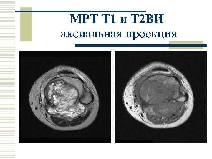 МРТ Т 1 и Т 2 ВИ аксиальная проекция 