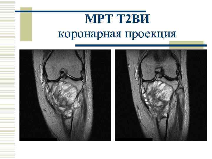 МРТ Т 2 ВИ коронарная проекция 