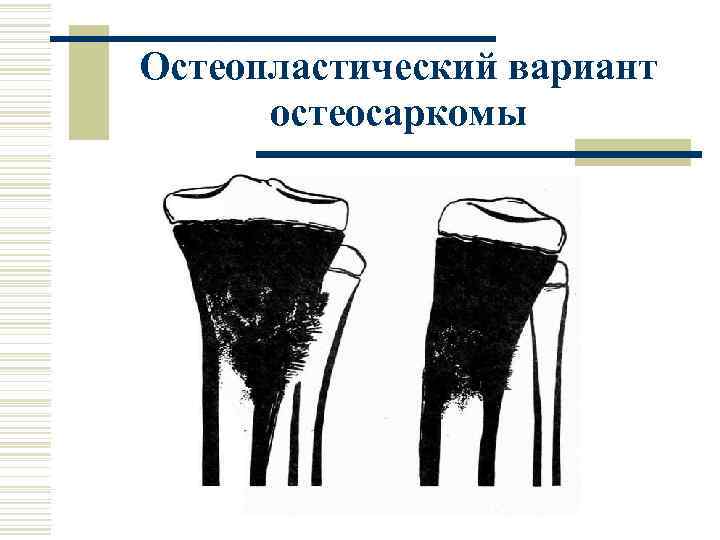 Остеопластический вариант остеосаркомы 