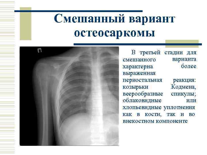 Смешанный вариант остеосаркомы В третьей стадии для варианта смешанного более характерна выраженная периостальная реакция: