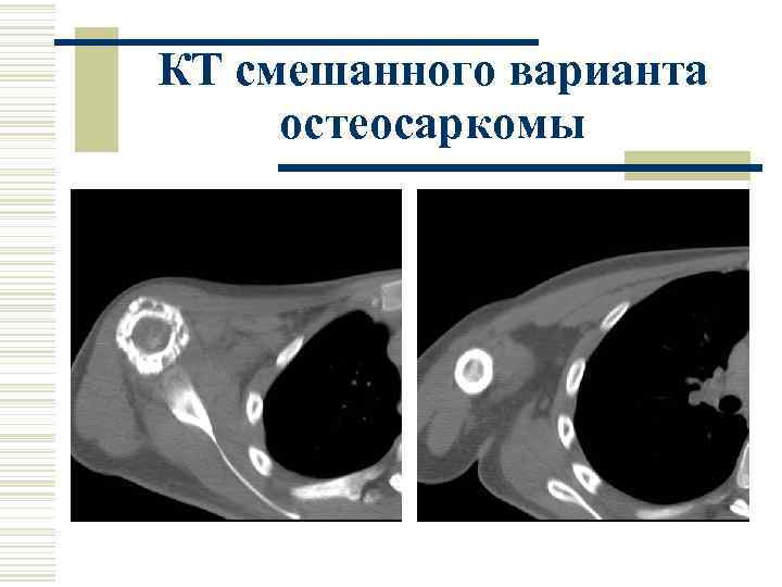 КТ смешанного варианта остеосаркомы 