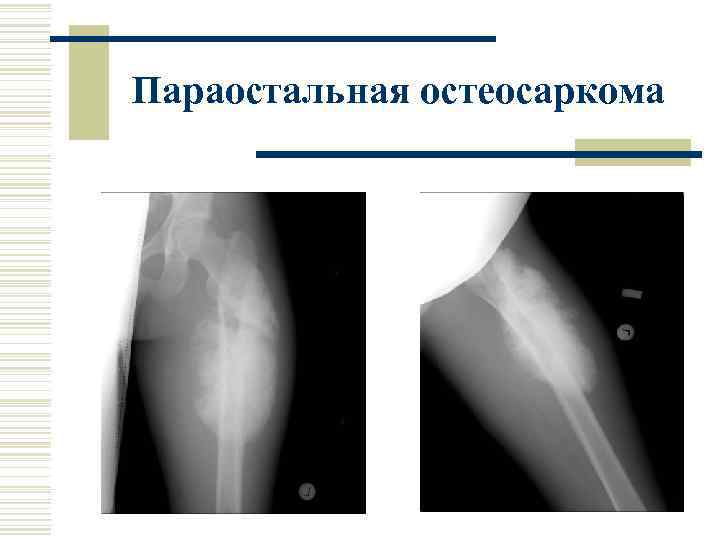 Параостальная остеосаркома 