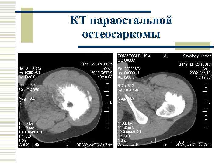 КТ параостальной остеосаркомы 