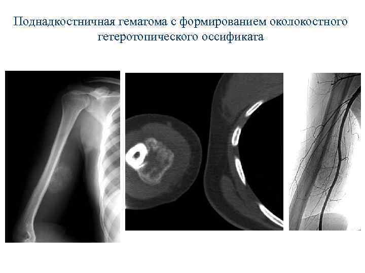 Поднадкостничная гематома с формированием околокостного гетеротопического оссификата 