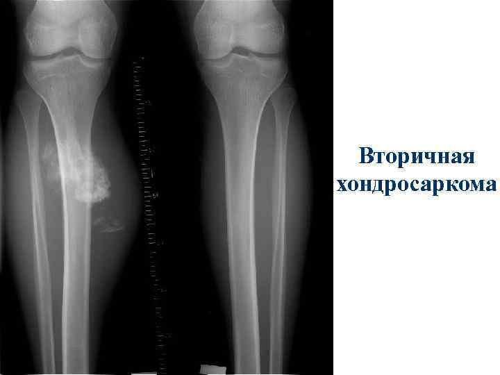 Вторичная хондросаркома 