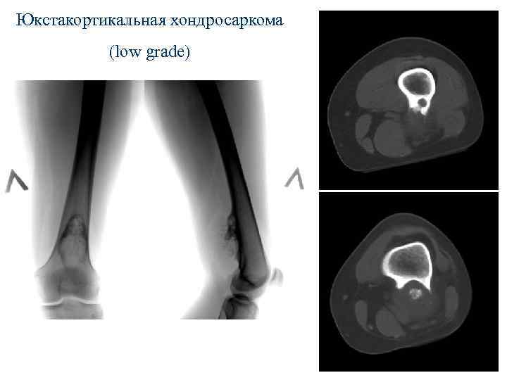 Юкстакортикальная хондросаркома (low grade) 