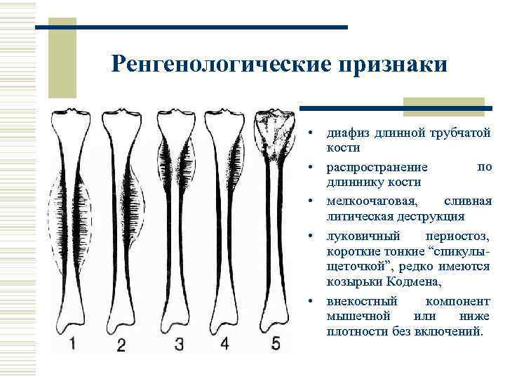 Ренгенологические признаки • диафиз длинной трубчатой кости по • распространение длиннику кости • мелкоочаговая,