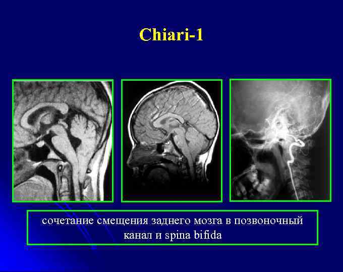 Сhiari-1 сочетание смещения заднего мозга в позвоночный канал и spina bifida 