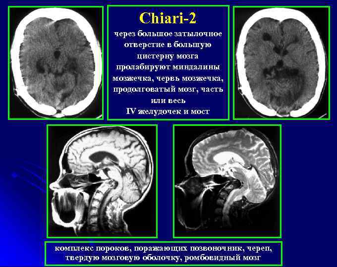 Chiari-2 через большое затылочное отверстие в большую цистерну мозга пролабируют миндалины мозжечка, червь мозжечка,