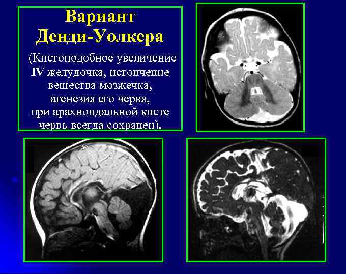 Вариант Денди-Уолкера (Кистоподобное увеличение IV желудочка, истончение вещества мозжечка, агенезия его червя, при арахноидальной