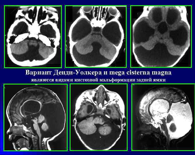 Вариант Денди-Уолкера и mega cisterna magna являются видами кистозной мальформации задней ямки 