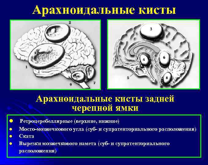 Арахноидальные кисты задней черепной ямки l l Ретроцеребеллярные (верхние, нижние) Мосто-мозжечкового угла (суб- и