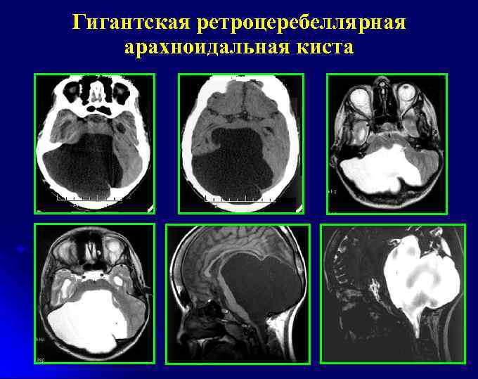 Гигантская ретроцеребеллярная арахноидальная киста 