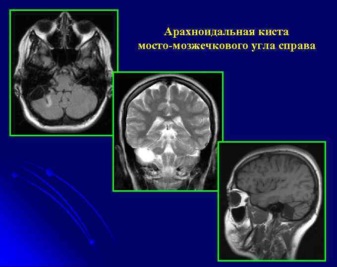 Арахноидальная киста мосто-мозжечкового угла справа 