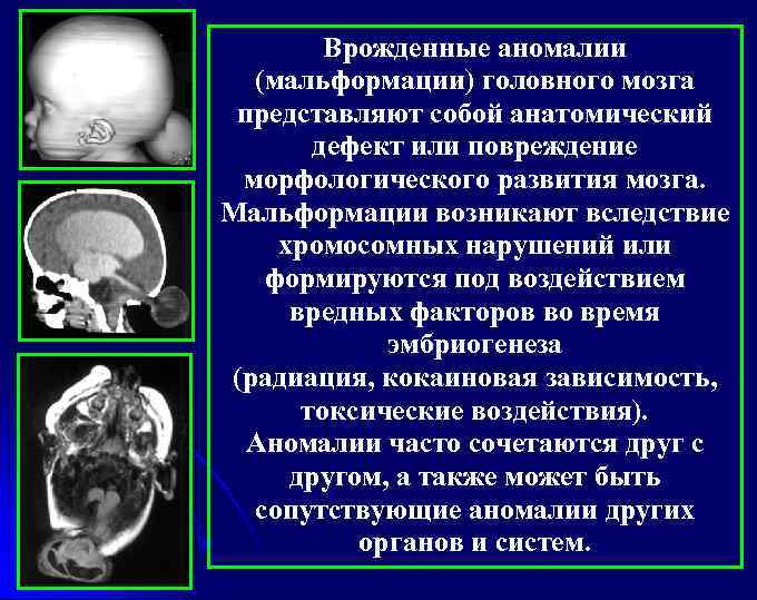 Врожденные аномалии (мальформации) головного мозга представляют собой анатомический дефект или повреждение морфологического развития мозга.