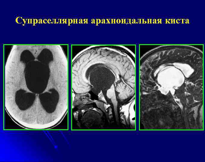 Супраселлярная арахноидальная киста 