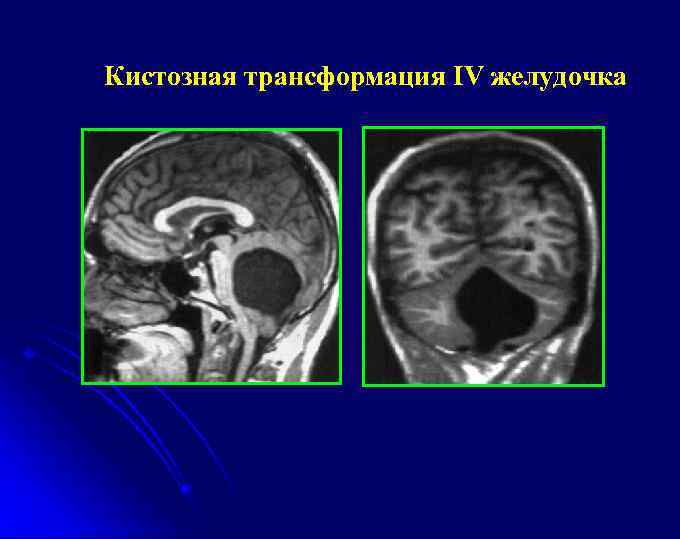 Кистозная трансформация IV желудочка 