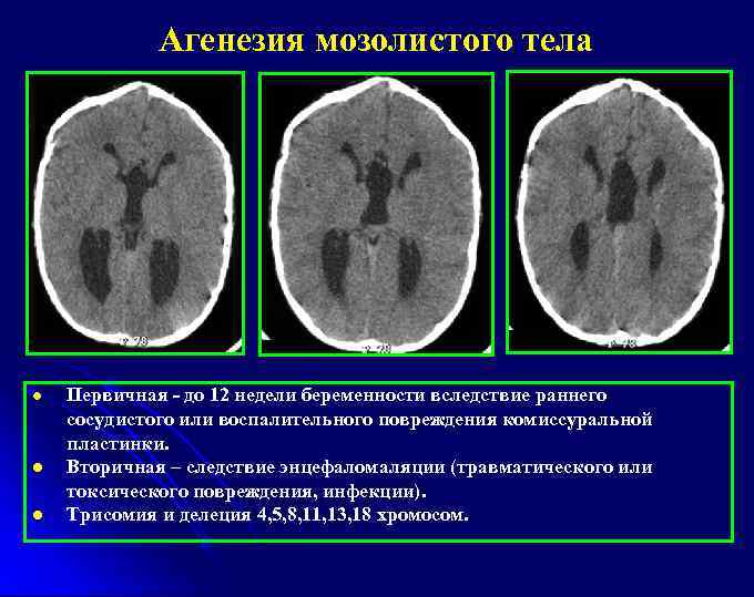 Агенезия мозолистого тела l l l Первичная - до 12 недели беременности вследствие раннего