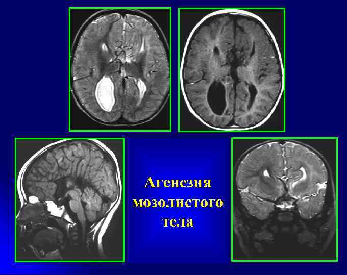 Агенезия мозолистого тела 