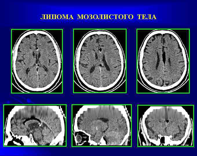 ЛИПОМА МОЗОЛИСТОГО ТЕЛА 