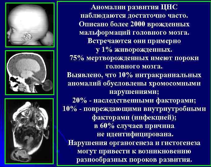 Аномалии развития ЦНС наблюдаются достаточно часто. Описано более 2000 врожденных мальформаций головного мозга. Встречаются