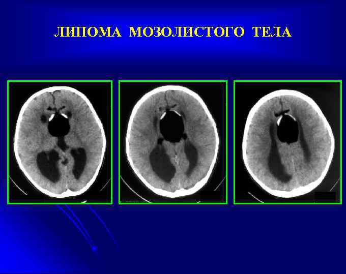 ЛИПОМА МОЗОЛИСТОГО ТЕЛА 