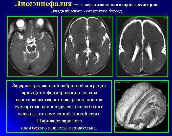 Лиссэнцефалия – генерализованная агирия-пахигирия «гладкий мозг» - отсутствие борозд Задержка радиальной нейронной миграции приводит