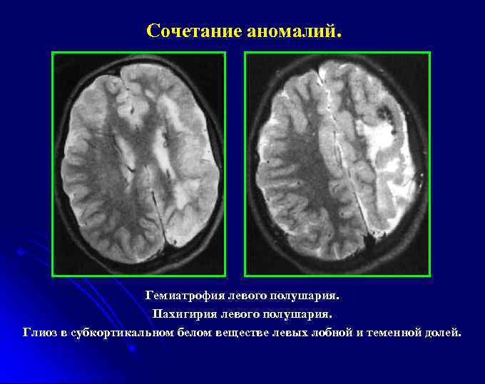 Сочетание аномалий. Гемиатрофия левого полушария. Пахигирия левого полушария. Глиоз в субкортикальном белом веществе левых