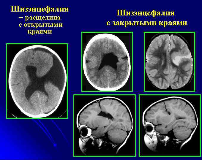 Шизэнцефалия – расщелина с открытыми краями Шизэнцефалия с закрытыми краями 