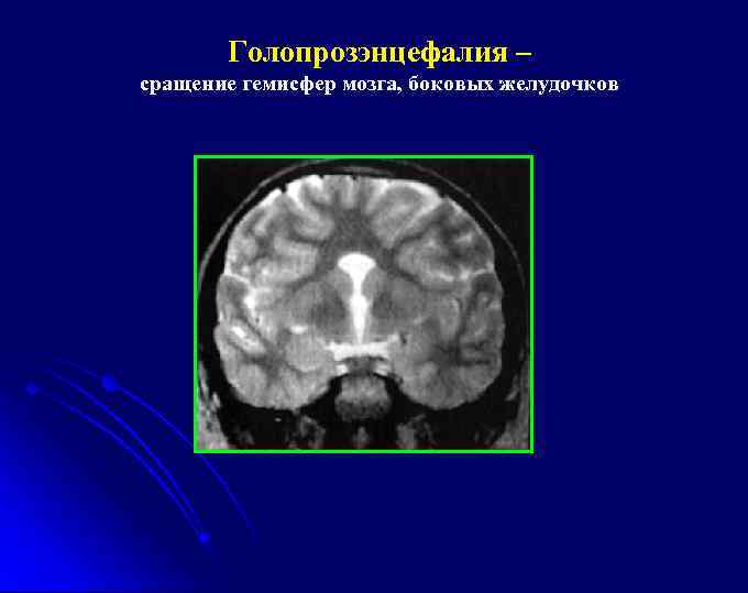 Голопрозэнцефалия – сращение гемисфер мозга, боковых желудочков 