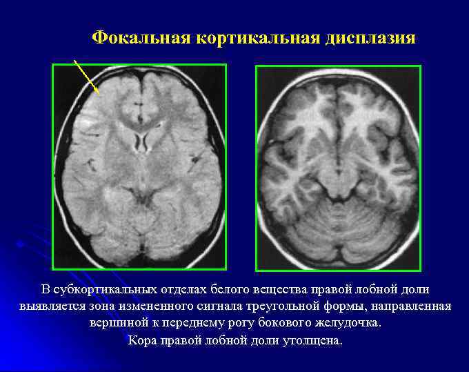 Фокальная кортикальная дисплазия В субкортикальных отделах белого вещества правой лобной доли выявляется зона измененного