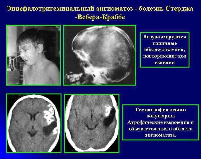 Энцефалотригеминальный ангиоматоз - болезнь Стерджа -Вебера-Краббе Визуализируются типичные обызвествления, повторяющие ход извилин Гемиатрофия левого