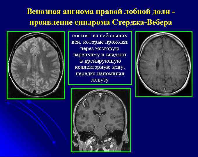 Венозная ангиома правой лобной доли проявление синдрома Стерджа-Вебера состоят из небольших вен, которые проходят