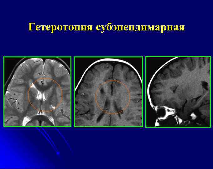 Гетеротопия субэпендимарная 