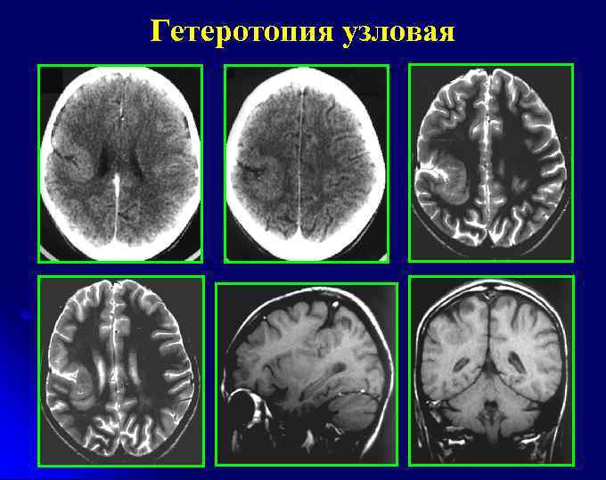 Гетеротопия узловая 