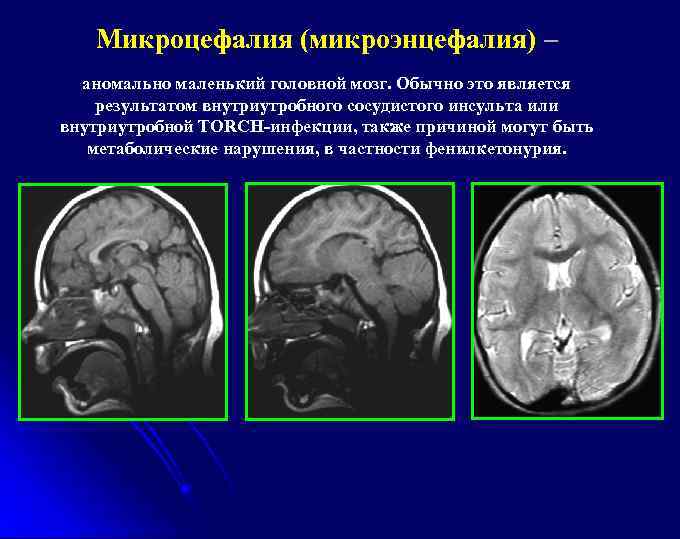 Микроцефалия (микроэнцефалия) – аномально маленький головной мозг. Обычно это является результатом внутриутробного сосудистого инсульта