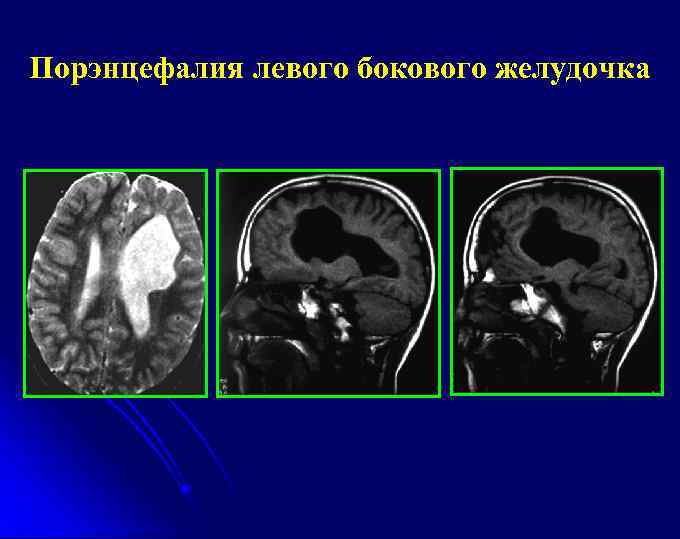 Порэнцефалия левого бокового желудочка 