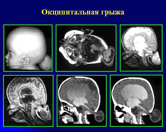 Окципитальная грыжа 