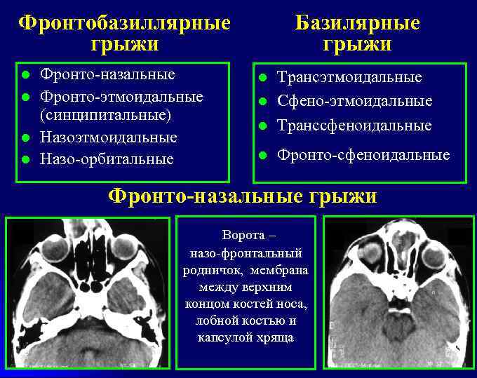 Фронтобазиллярные грыжи l l Фронто-назальные Фронто-этмоидальные (синципитальные) Назоэтмоидальные Назо-орбитальные Базилярные грыжи l Трансэтмоидальные Сфено-этмоидальные