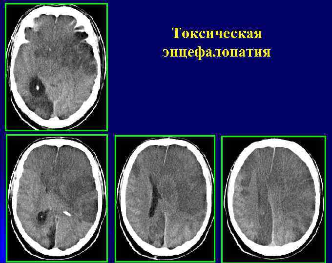 Токсическая энцефалопатия 