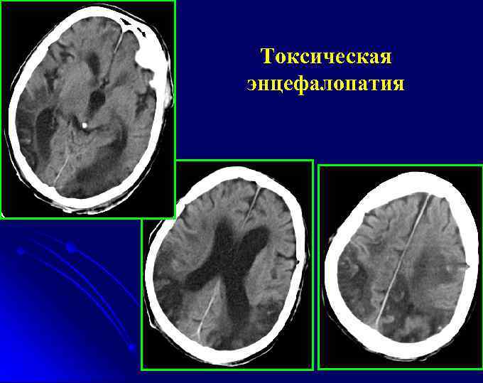 Токсическая энцефалопатия 