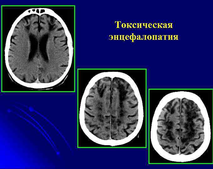 Токсическая энцефалопатия 