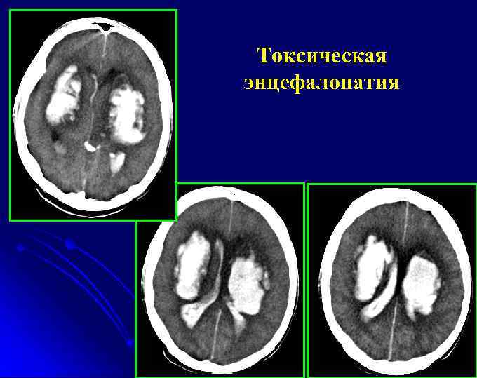 Токсическая энцефалопатия 