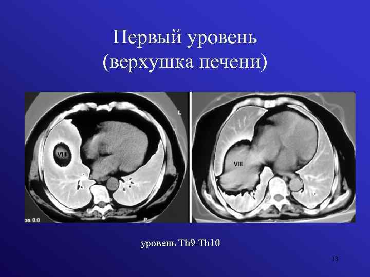 Первый уровень (верхушка печени) уровень Th 9 -Th 10 13 