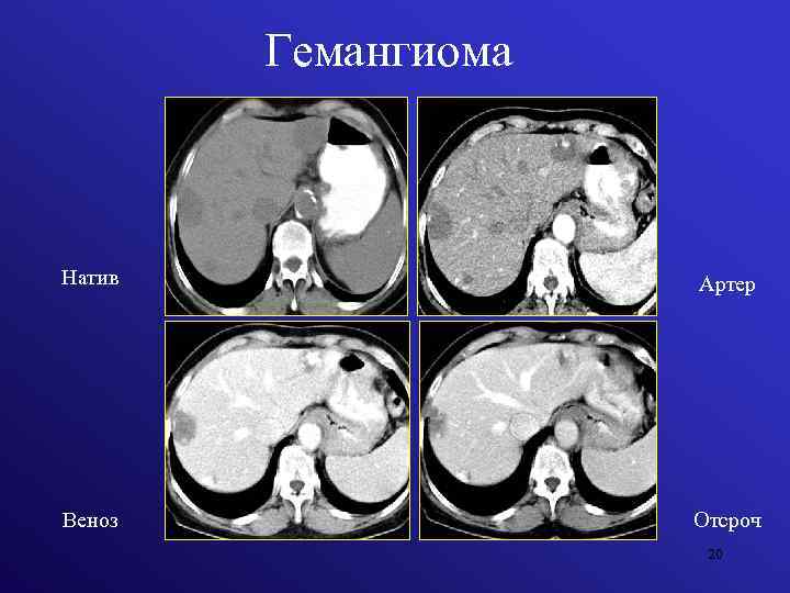 Гемангиома Натив Артер Веноз Отсроч 20 