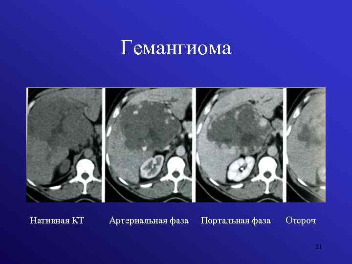 Гемангиома Нативная КТ Артериальная фаза Портальная фаза Отсроч 21 