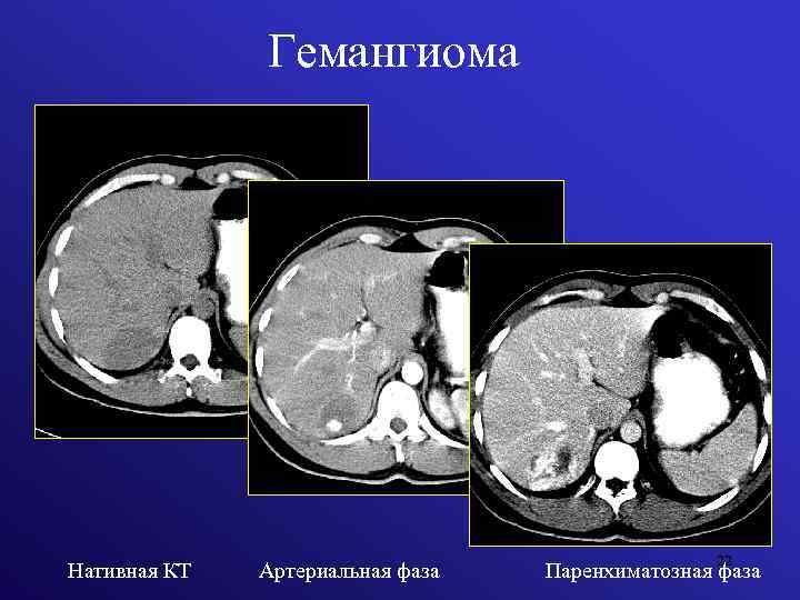 Гемангиома Нативная КТ Артериальная фаза 22 Паренхиматозная фаза 