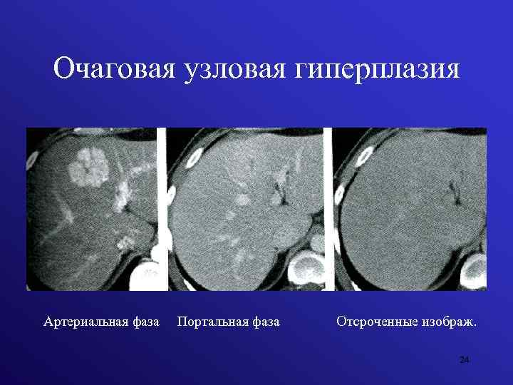 Очаговая узловая гиперплазия Артериальная фаза Портальная фаза Отсроченные изображ. 24 